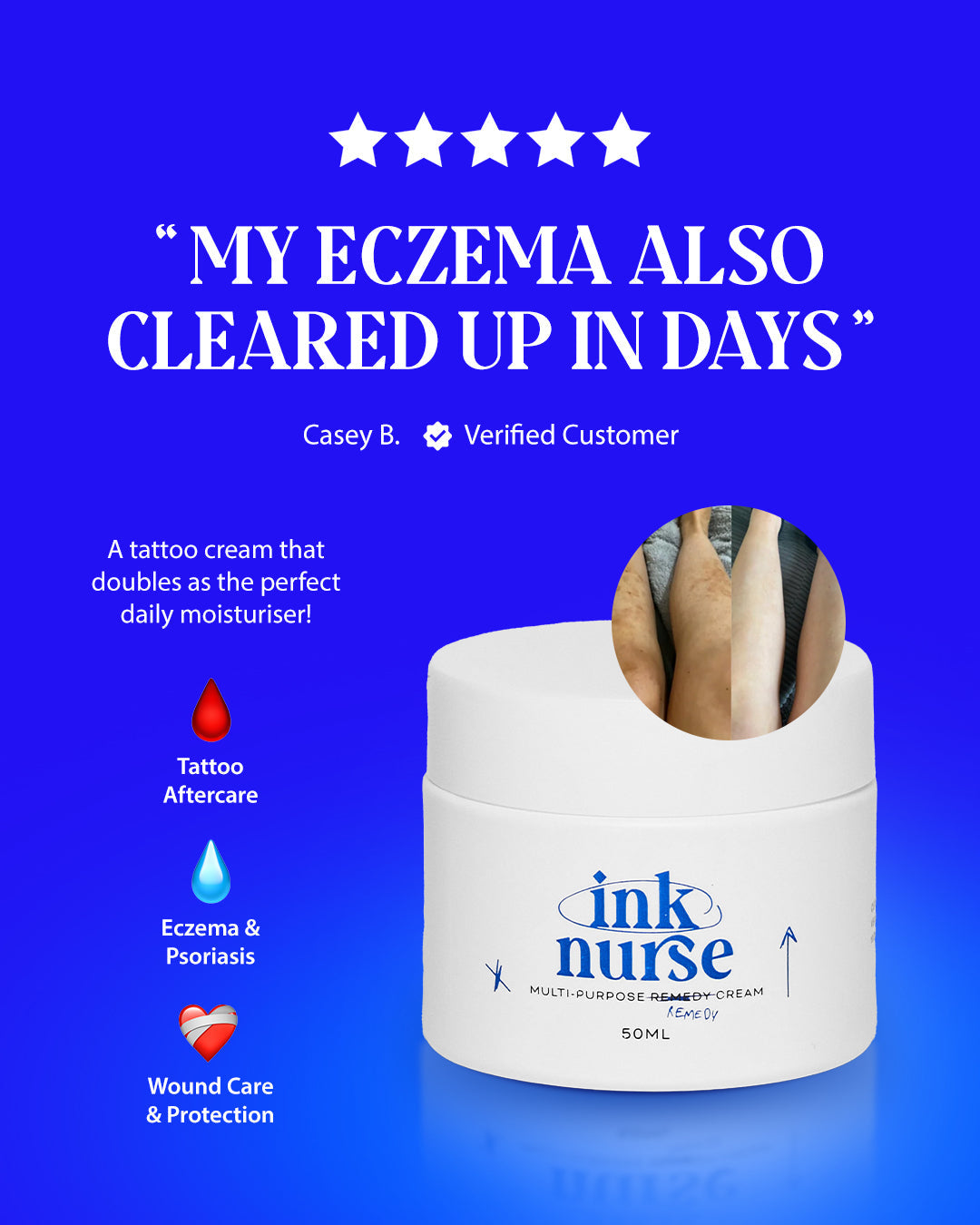 Why Tattoo Customers Started Using Ink Nurse for Eczema